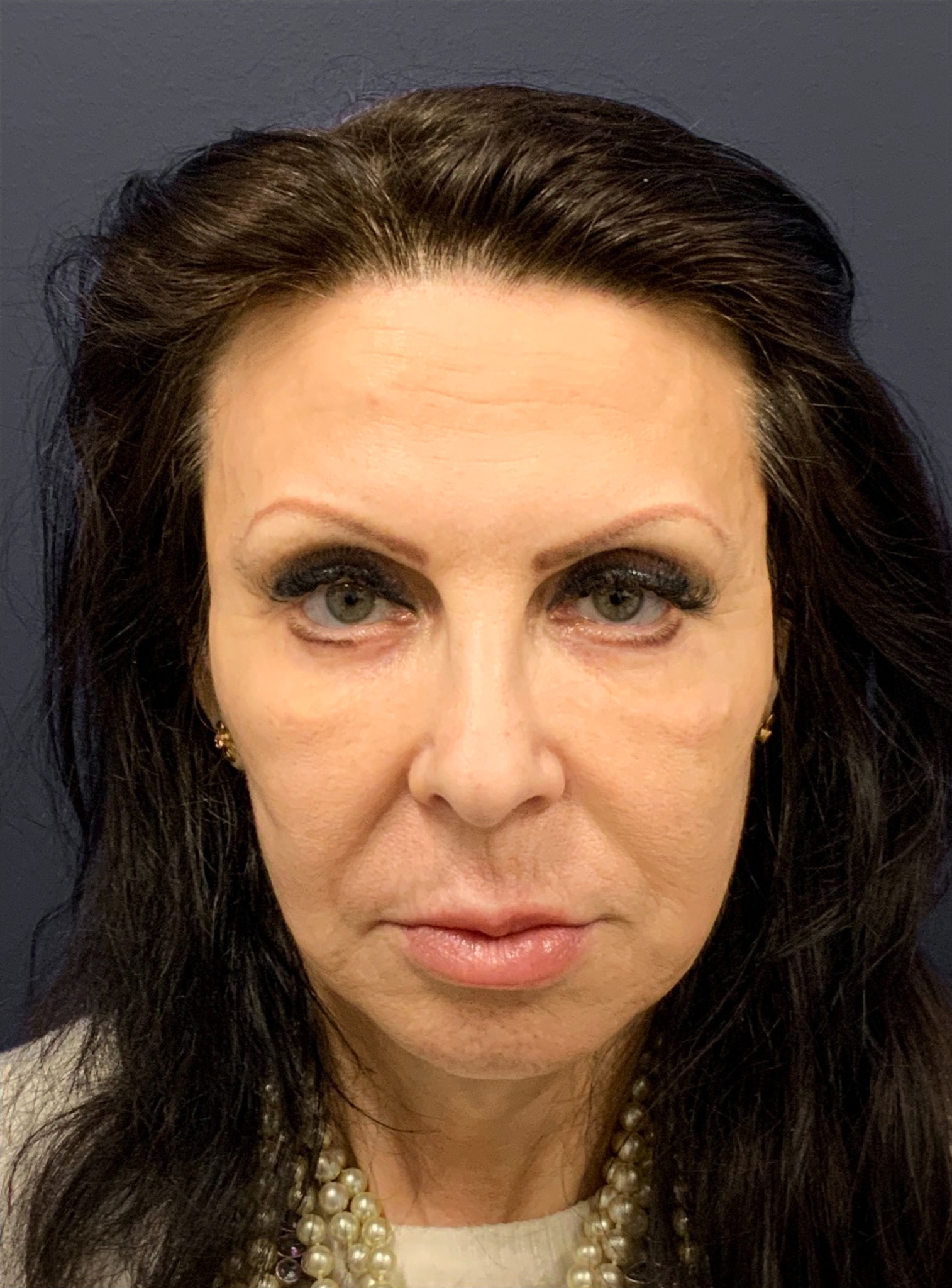 Blepharoplasty-Case--6272 | After Eyelid Surgery 6