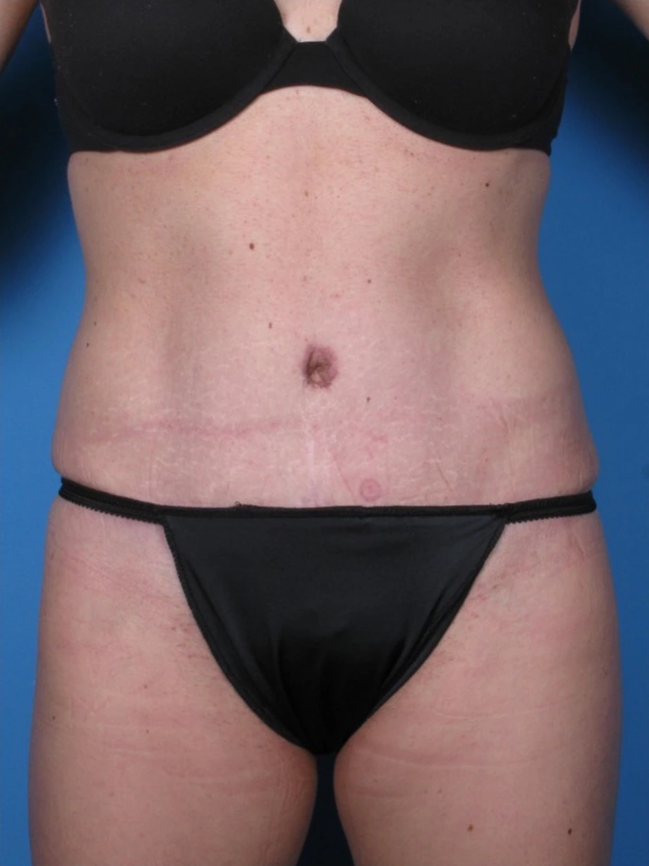 Tummy-Tuck-Case--250 | After Tummy Tuck 1