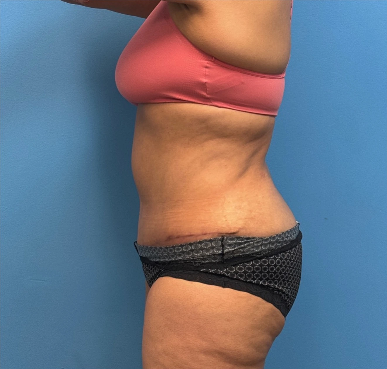 Lipoabdominoplasty-Case--27602 | After Liposuction 2
