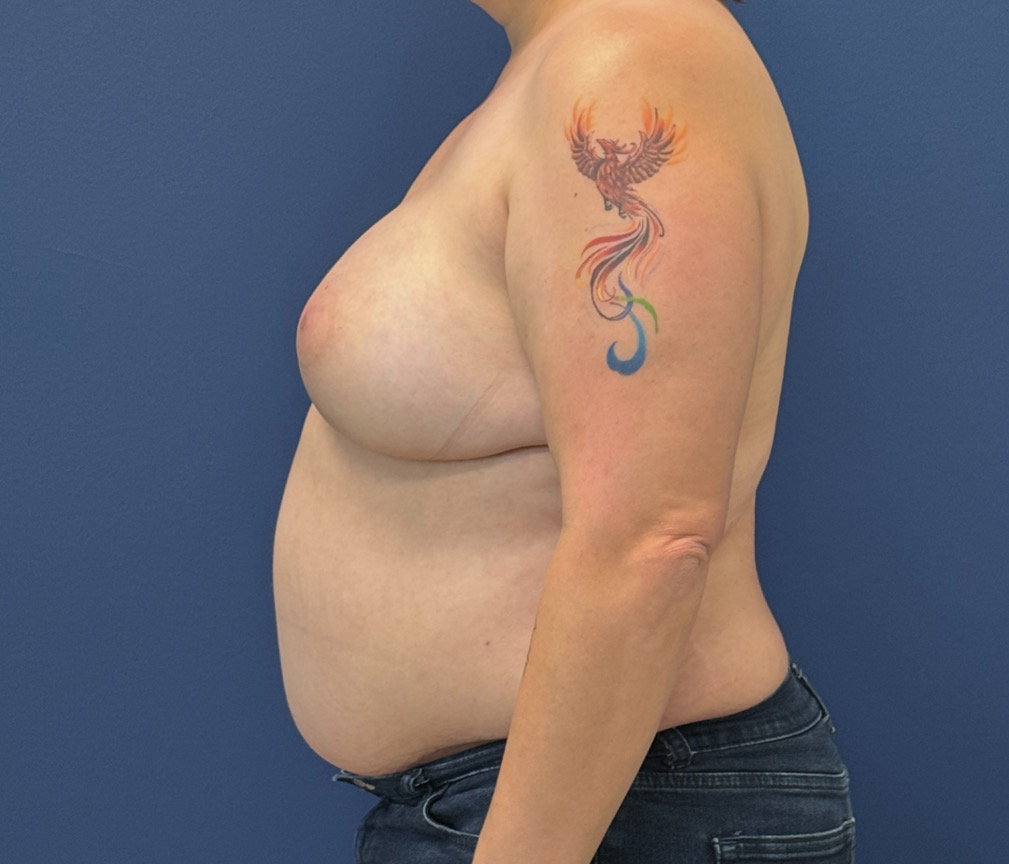 DIEP-Flap-Case--28021 | After Dr. Samir Rao 2