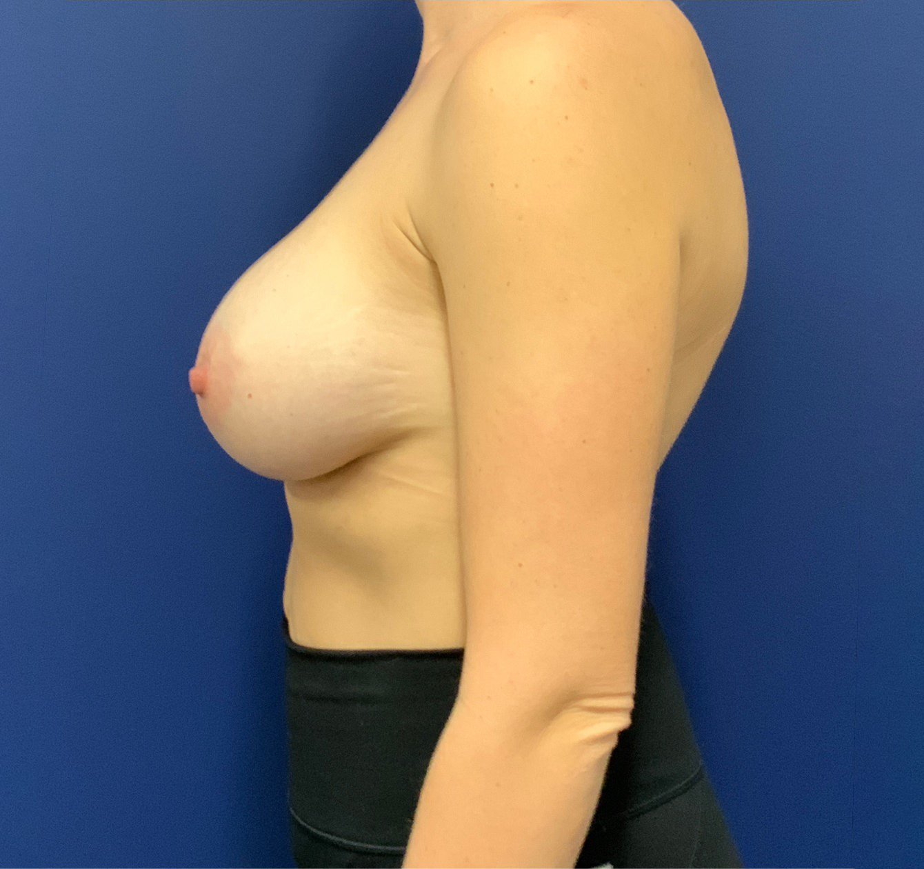 Breast-Augmentation-Case--20570 | After Breast Augmentation 3