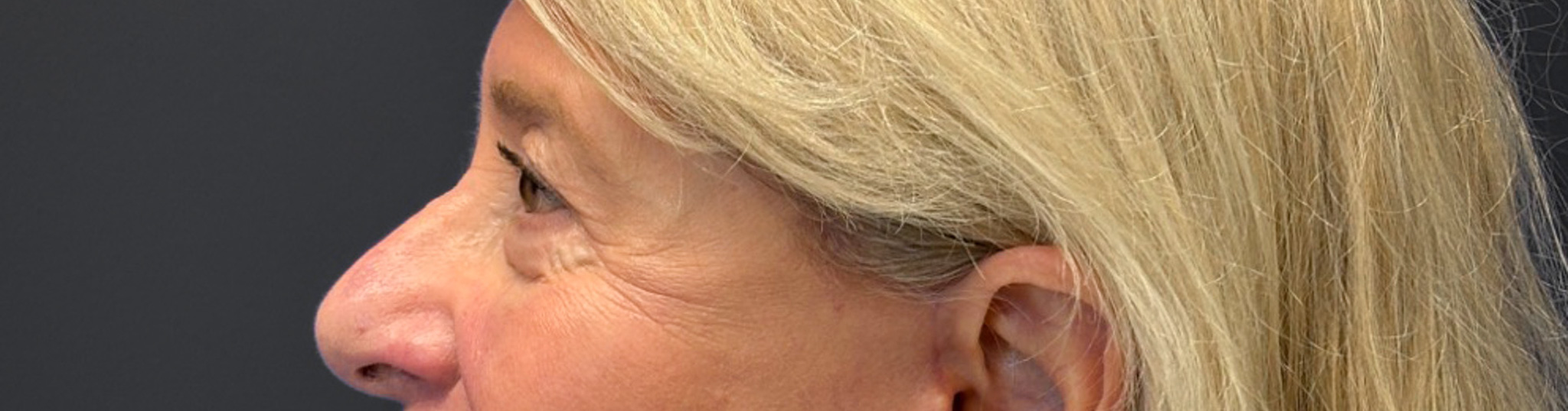 Blepharoplasty-Case--3336 | After Eyelid Surgery 3