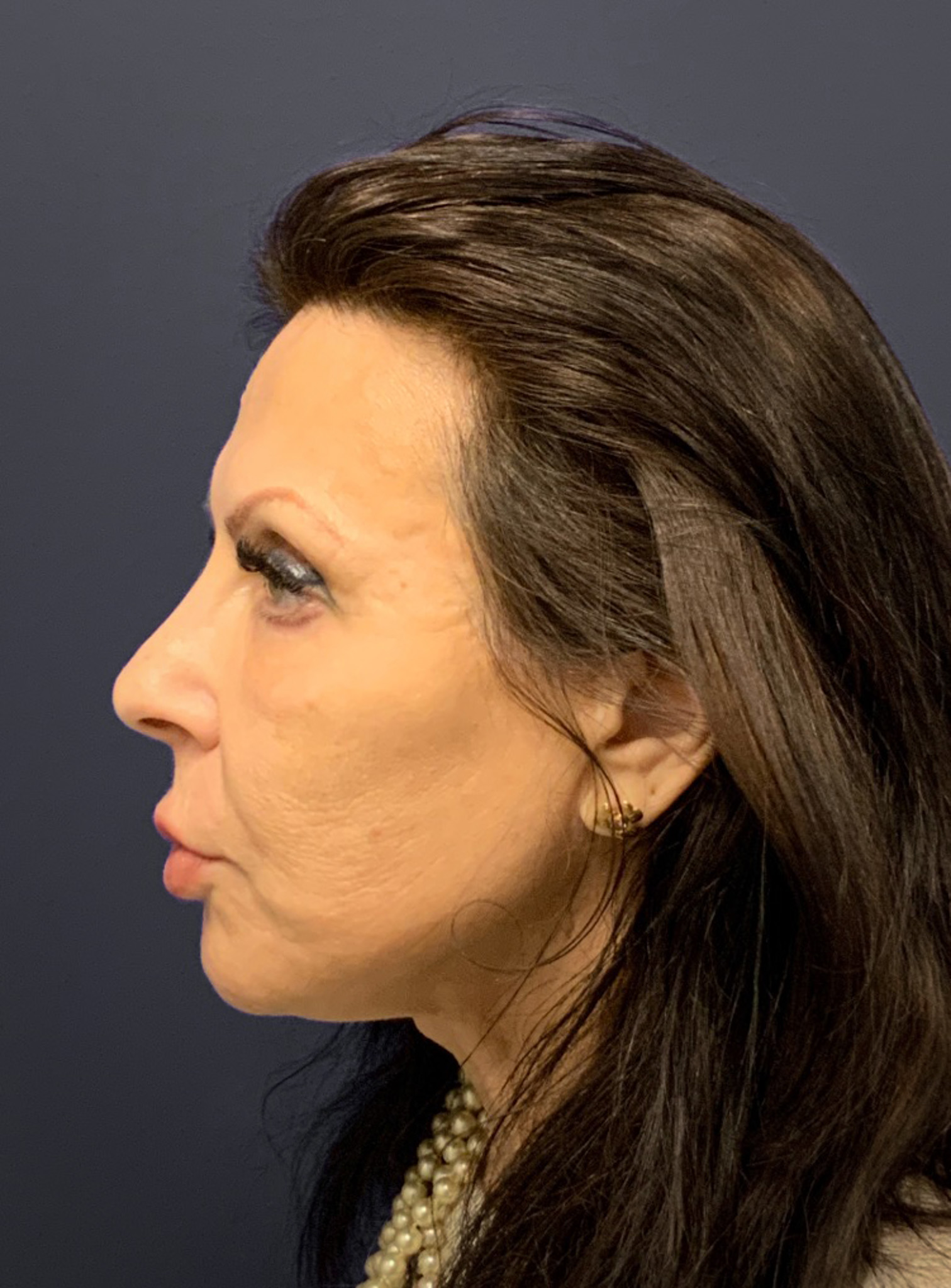 Blepharoplasty-Case--6272 | After Eyelid Surgery 7