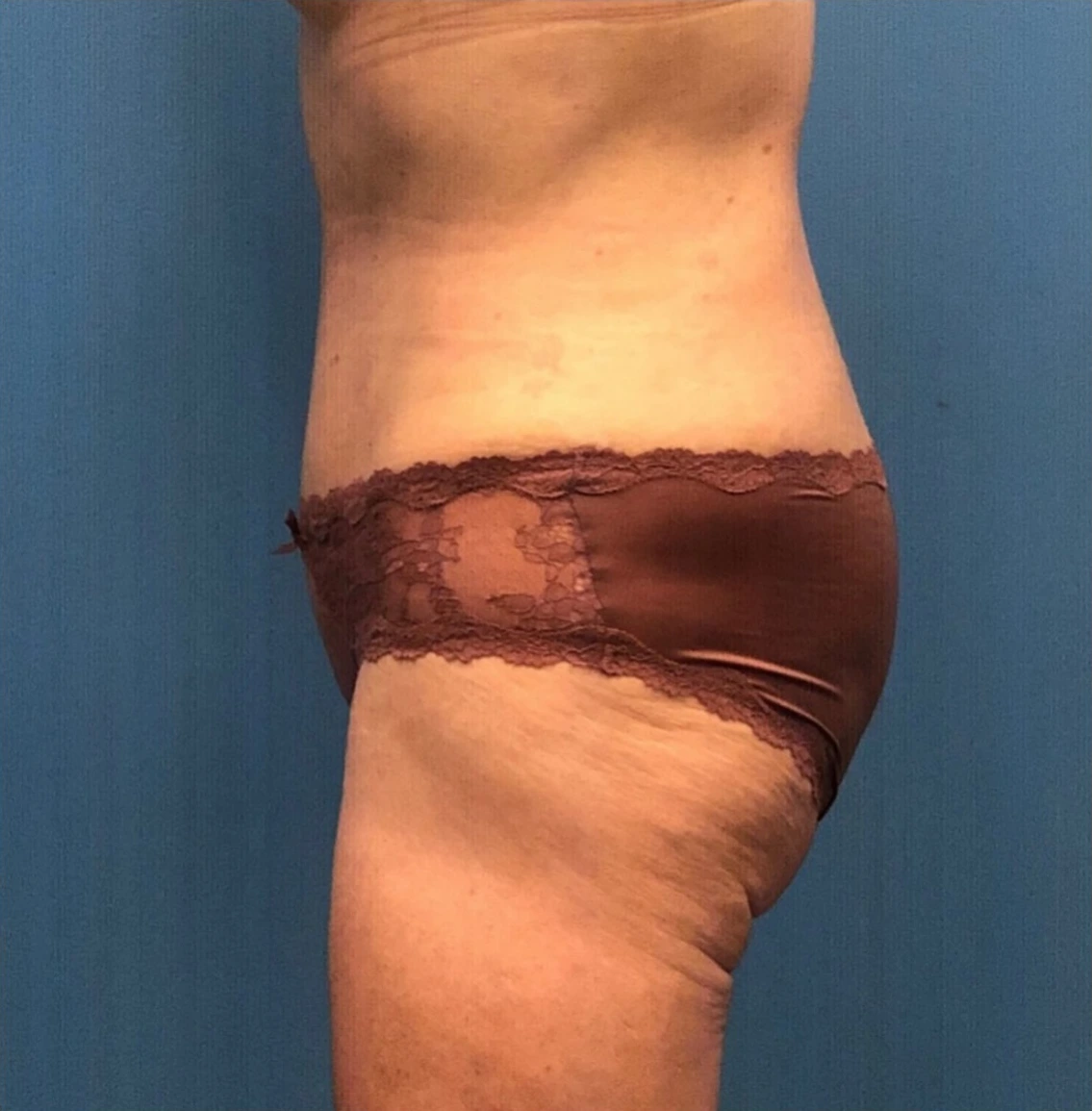 Case--251 | After Body 2