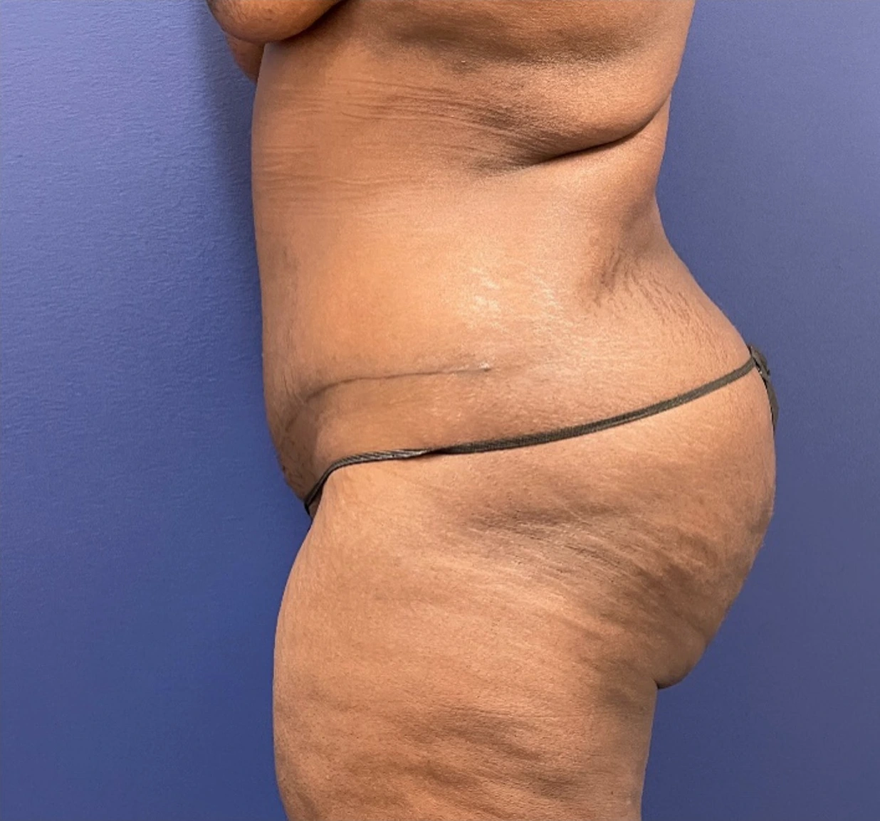 Case--257 | After Body 2