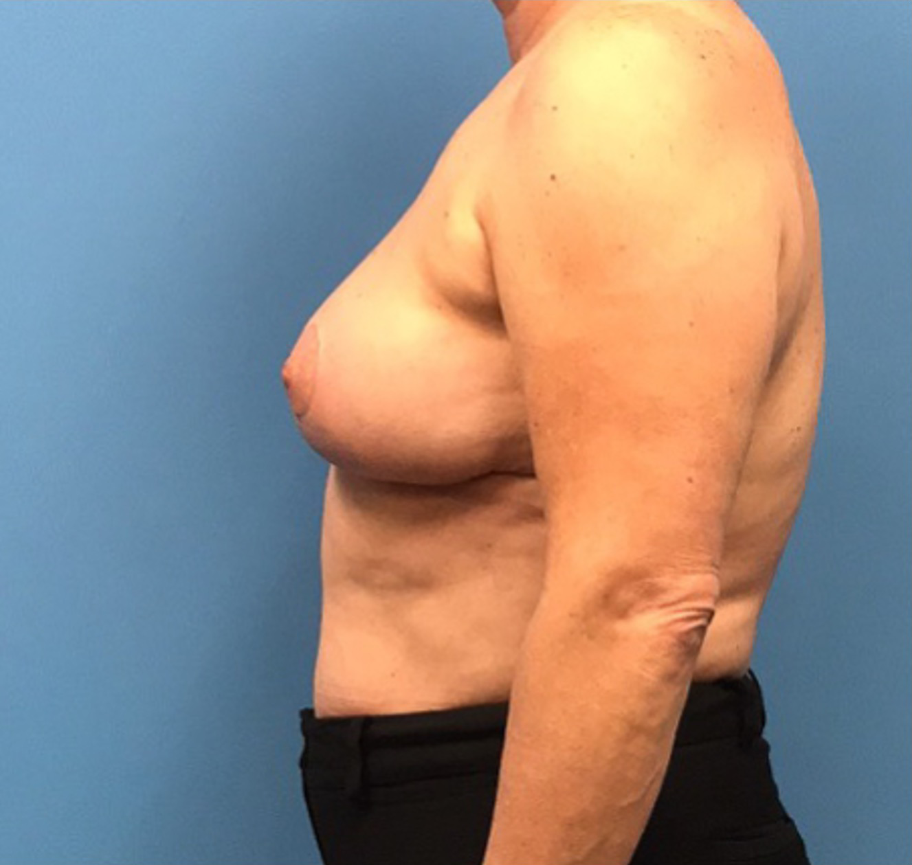 Case--314 | After Breast Reconstruction 2