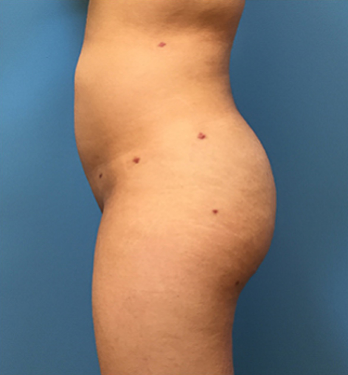 Brazilian-Butt-Lift-Case--73 | After Body 2
