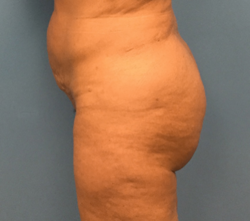 Brazilian-Butt-Lift-Case--74 | After Body 1