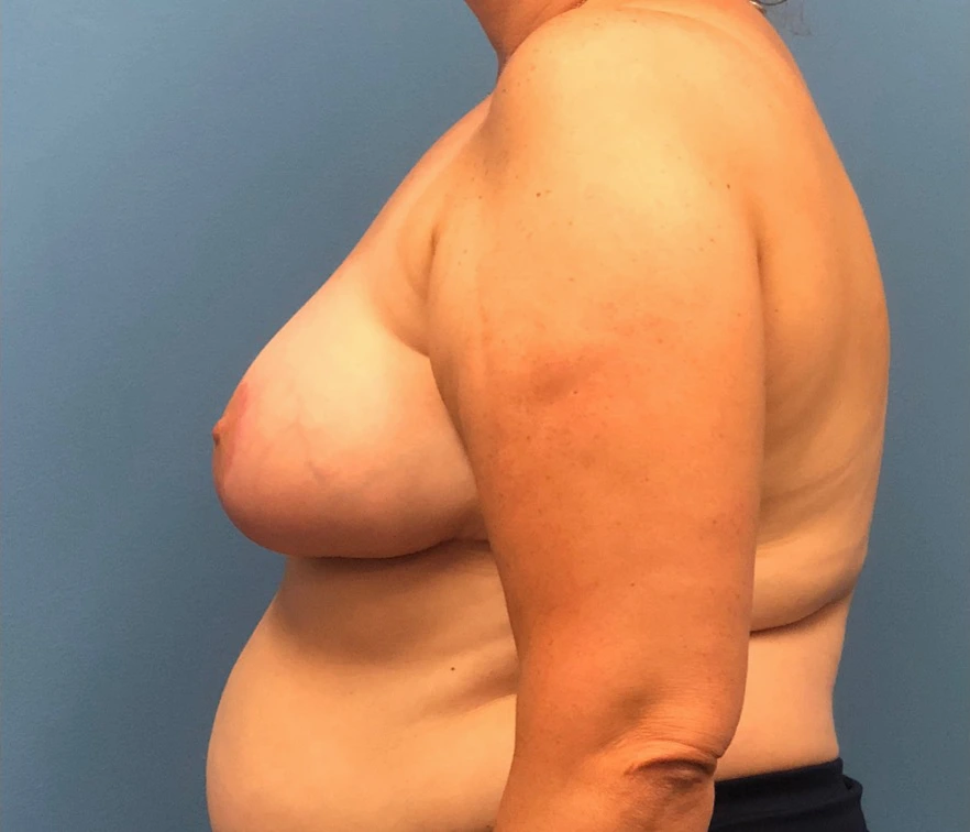Breast-Reduction-Case--13597 | After Breast Reduction 3