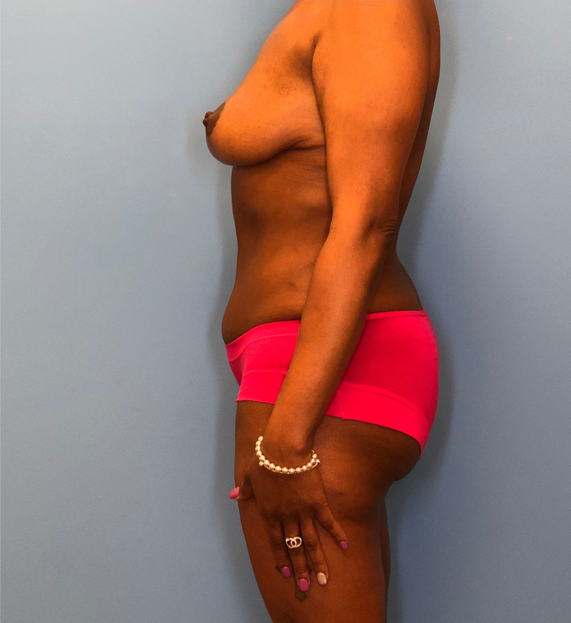 Mommy-Makeover-Case--13869 | After Body 2