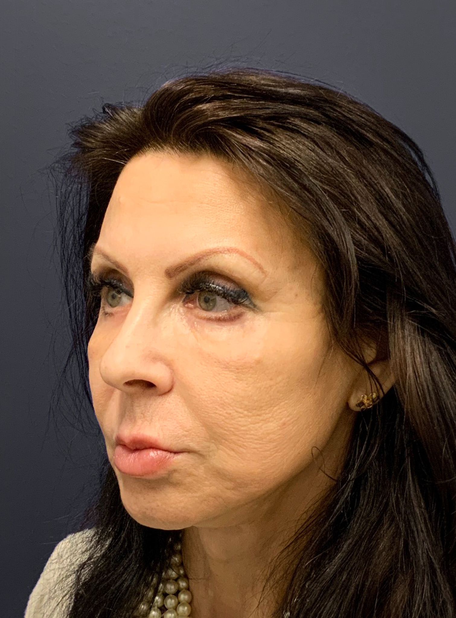 Blepharoplasty-Case--6272 | After Eyelid Surgery 9