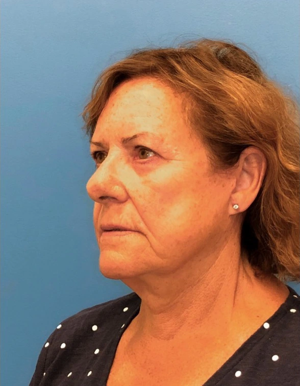 Facelift-Case--14406 | After Eyelid Surgery 2