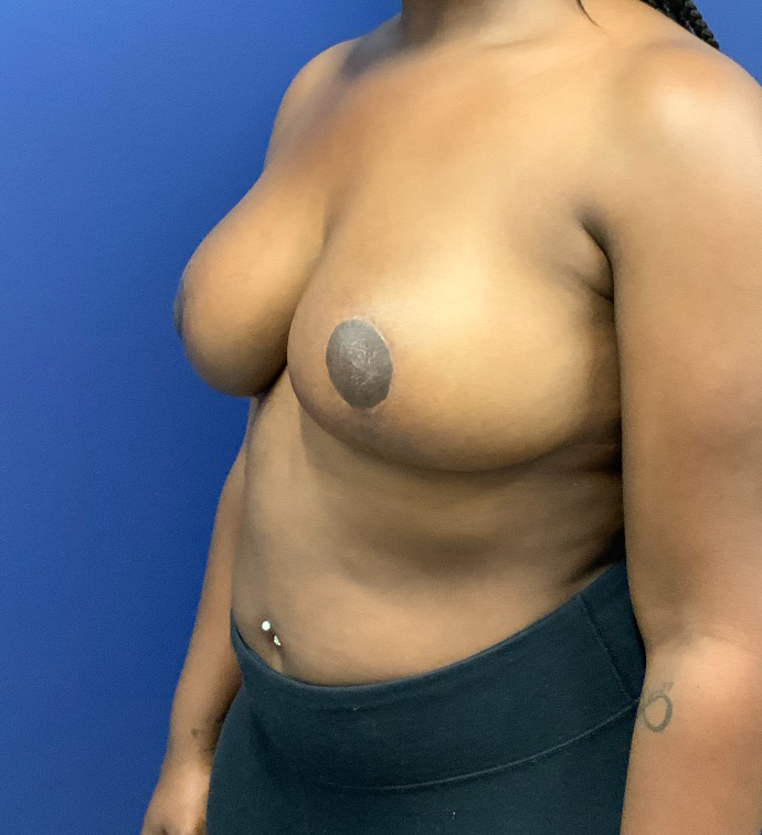 Breast-Reduction-Case--27530 | After Dr. Arjun Kanuri 2