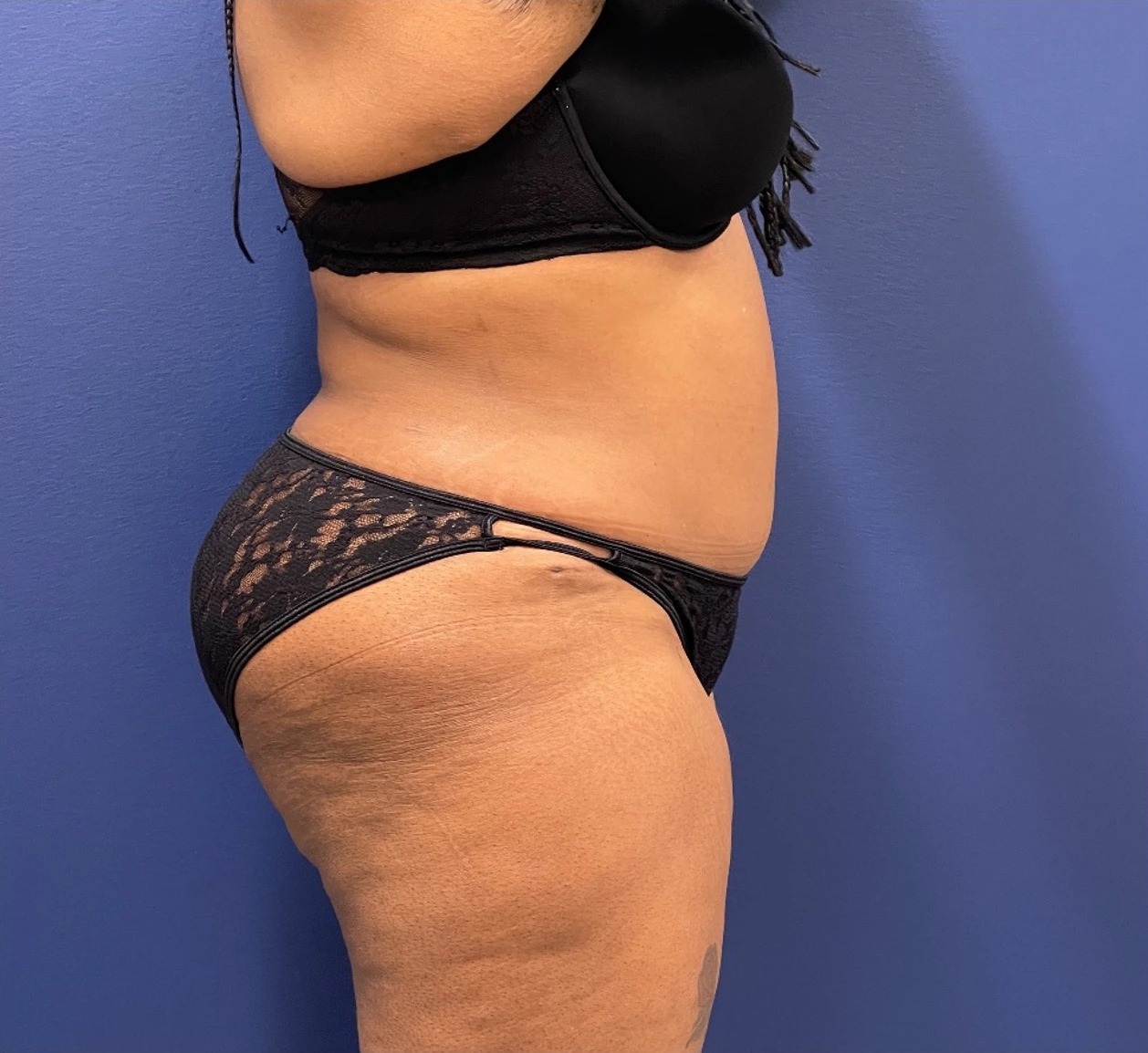 Lipoabdominoplasty-Case--245 | After Body 2