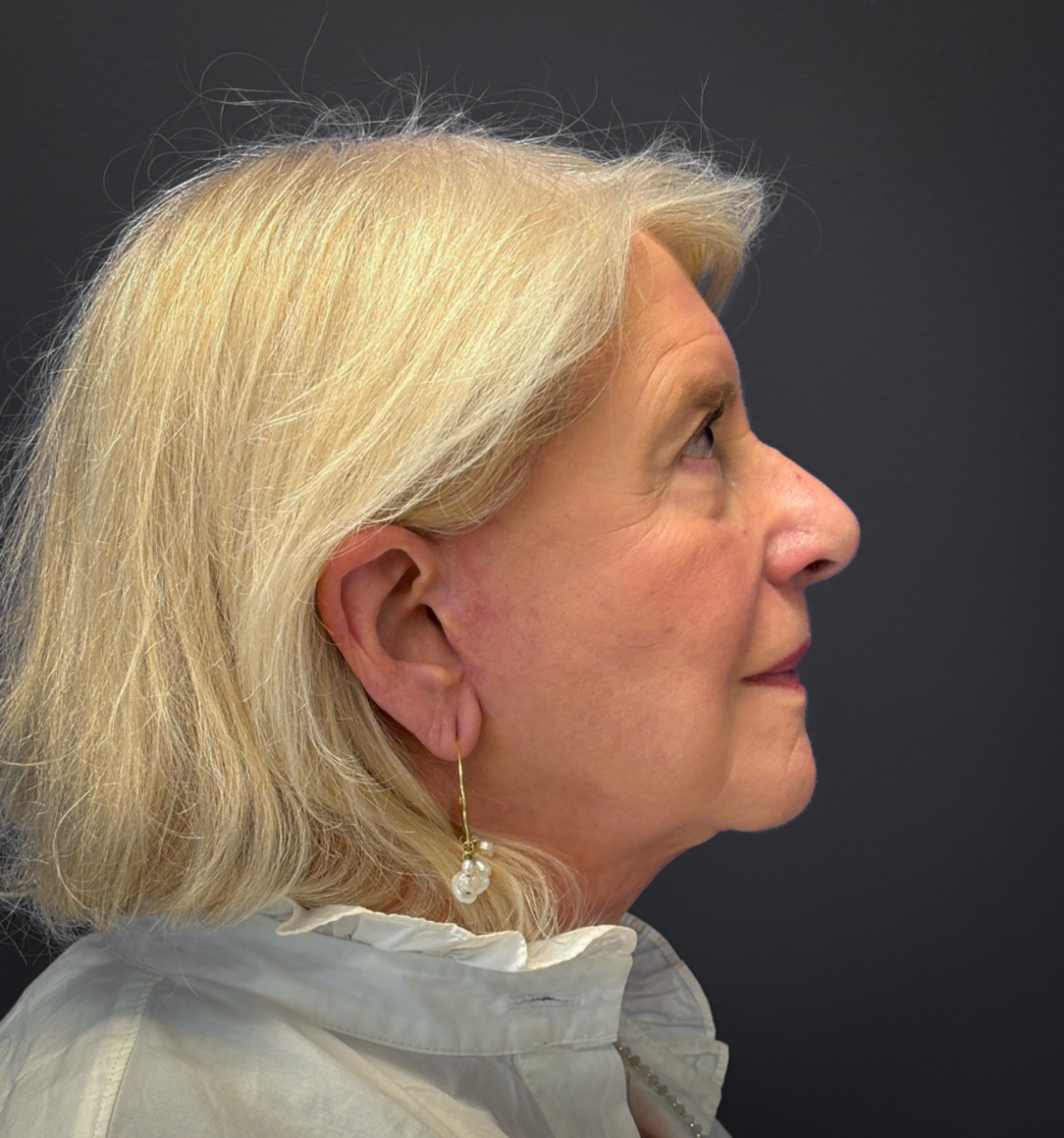 Blepharoplasty-Case--3336 | After Eyelid Surgery 7