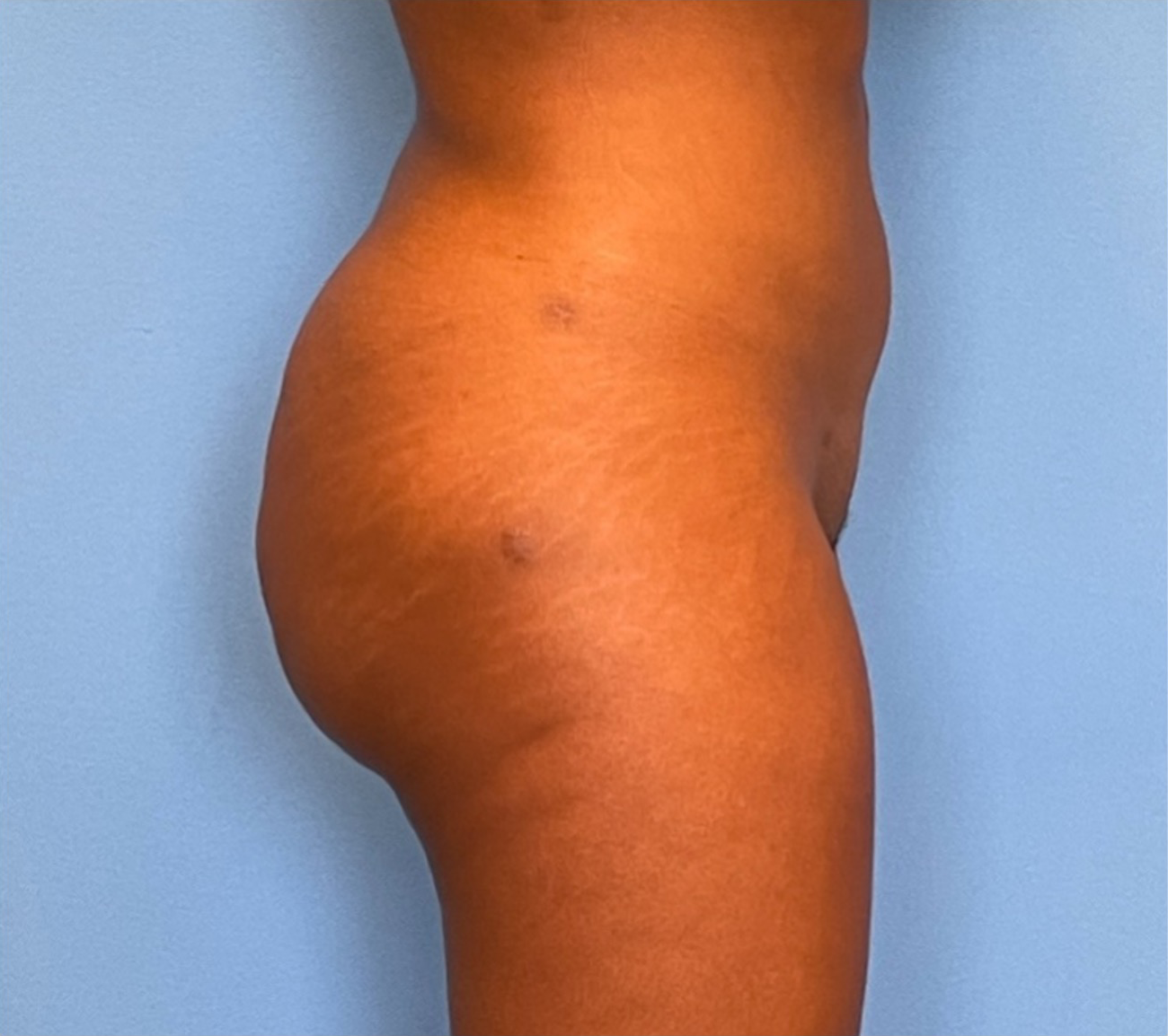 Brazilian-Butt-Lift-Case--263 | After Brazilian Butt Lift 3
