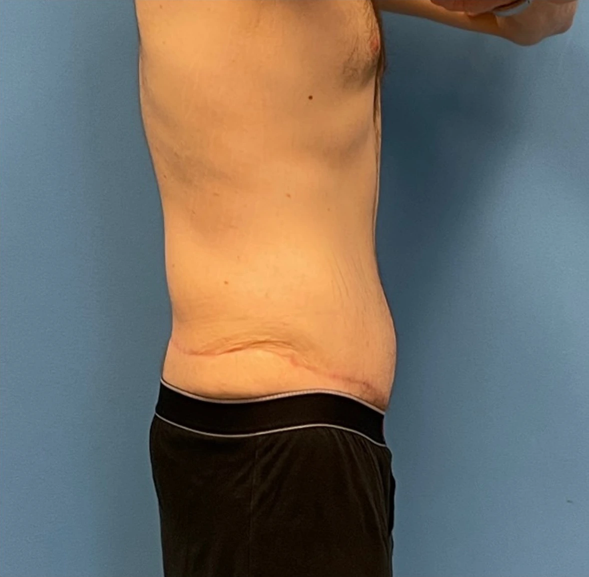 Body-Lift-Case--273 | After Body 2