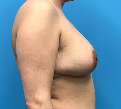 Breast-Reduction-Case--132 | After Breast Reduction 3