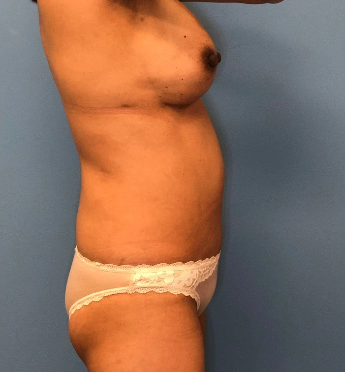Case--11542 | After Breast Reconstruction 3