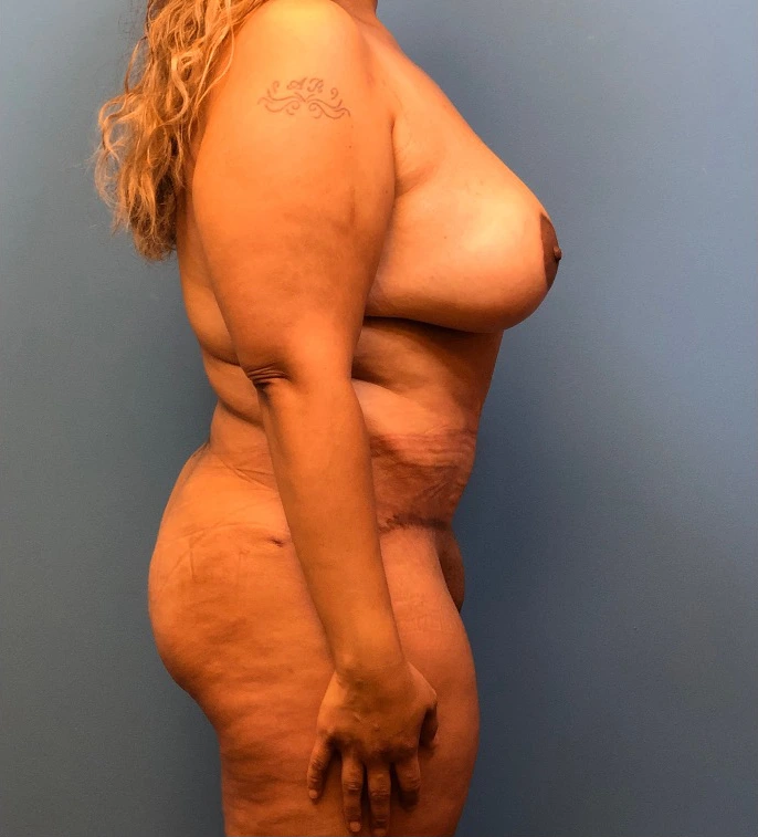 Lipoabdominoplasty-Breast-Augmentation-Case--15133 | After Mommy Makeover 3