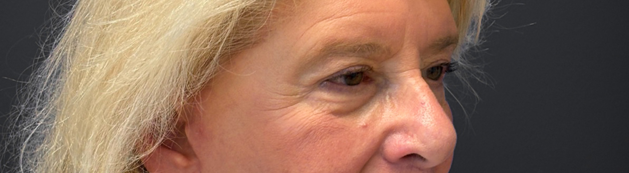 Blepharoplasty-Case--3336 | After Eyelid Surgery 4