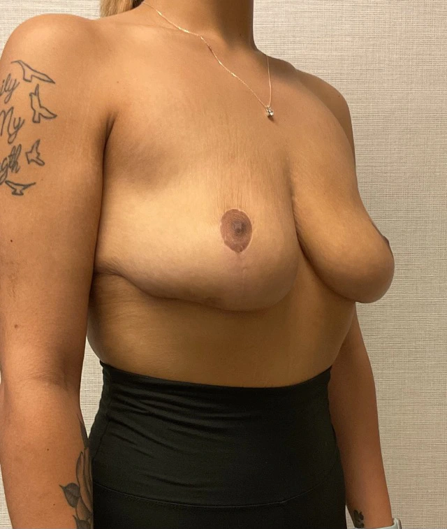 Breast-Reduction-Case--212 | After Breast Reduction 3