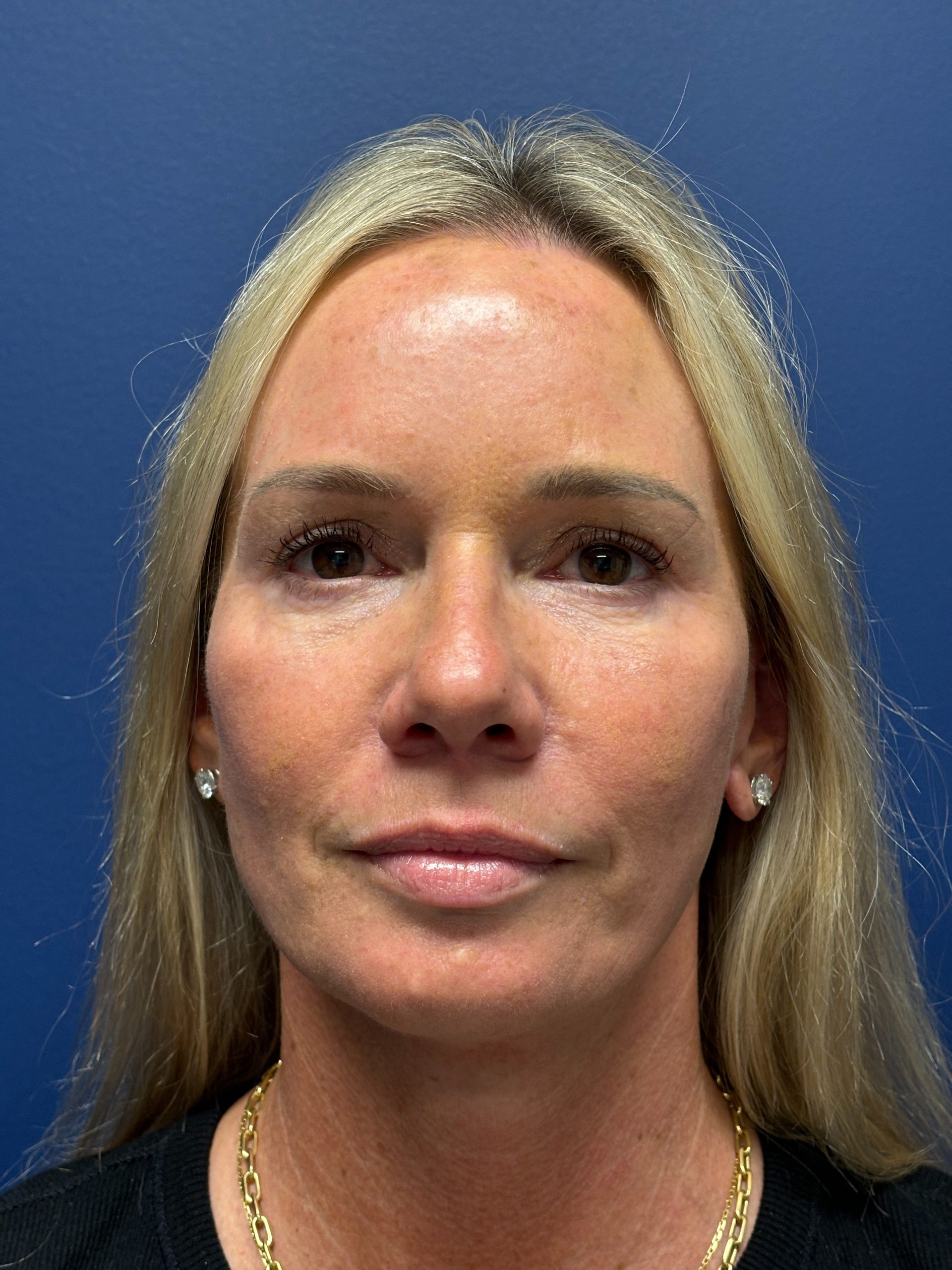 Facelift-Facial-Fat-Grafting-Necklift-Blepharoplasty-Case--9823 | After Eyelid Surgery 1
