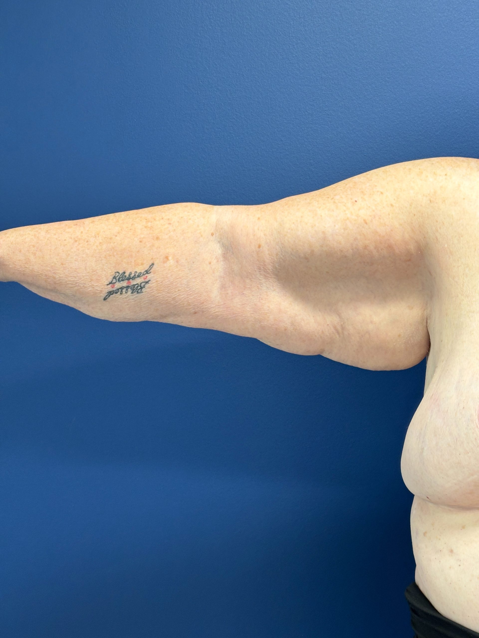 Brachioplasty-Case--3447 | Before Body 2