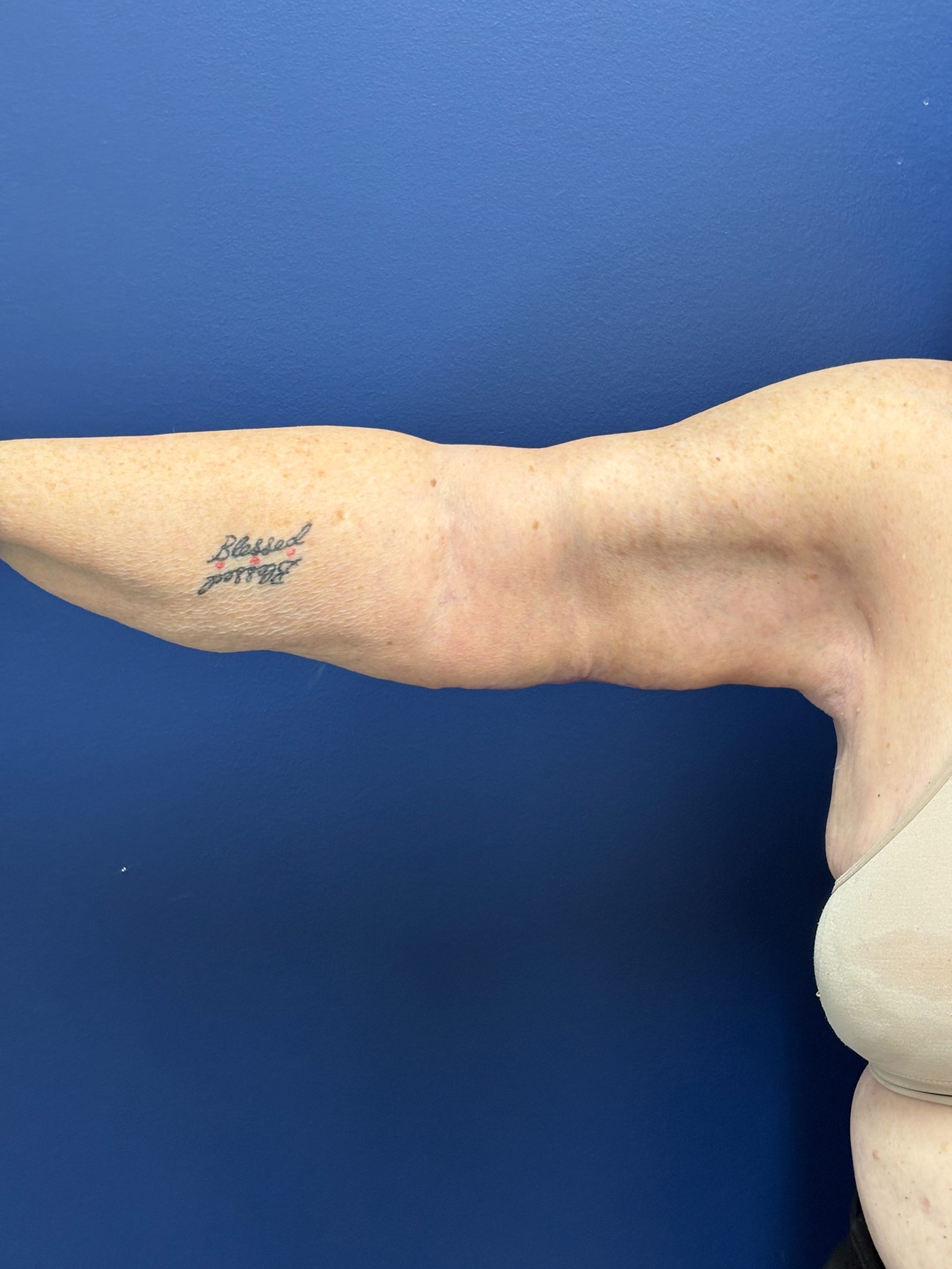 Brachioplasty-Case--3447 | After Body 2