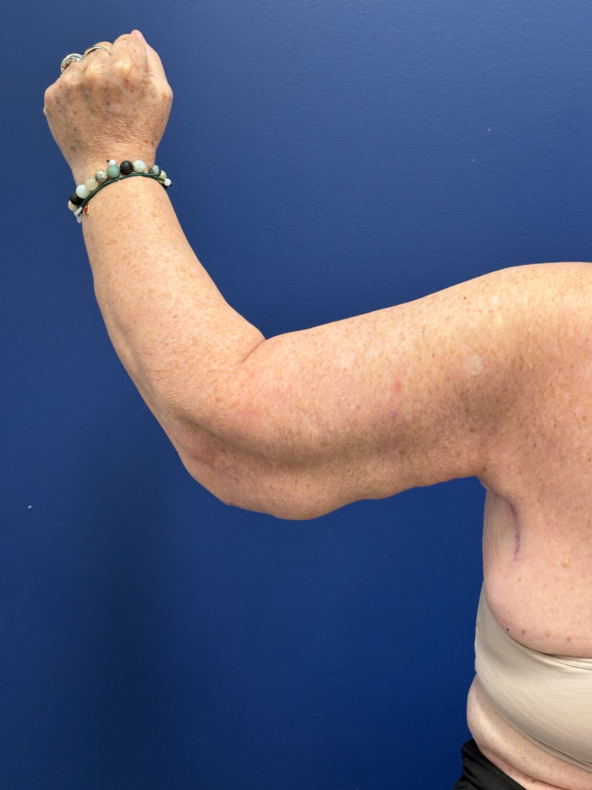 Brachioplasty-Case--3447 | After Arm Lift 8
