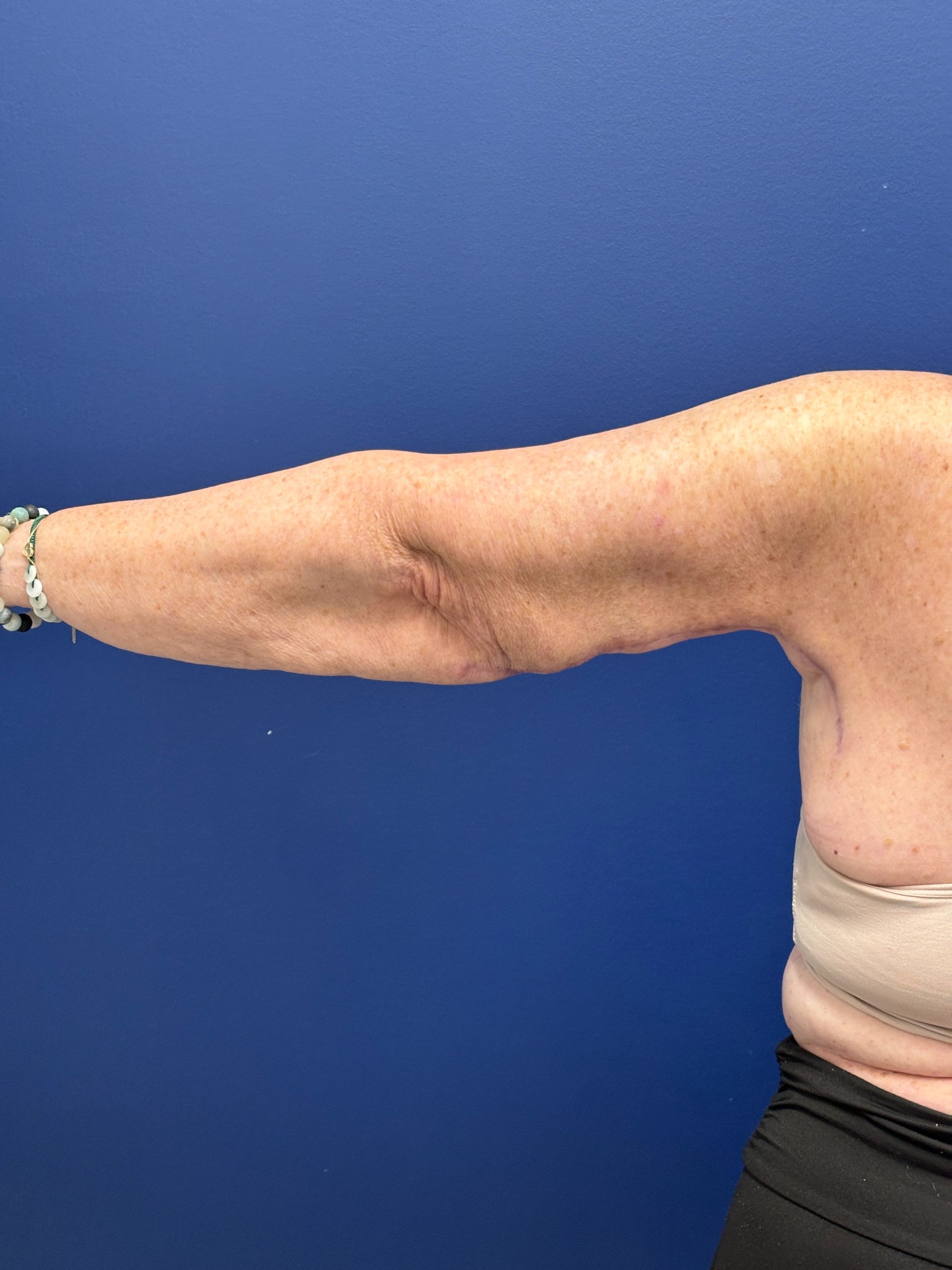 Brachioplasty-Case--3447 | After Arm Lift 4