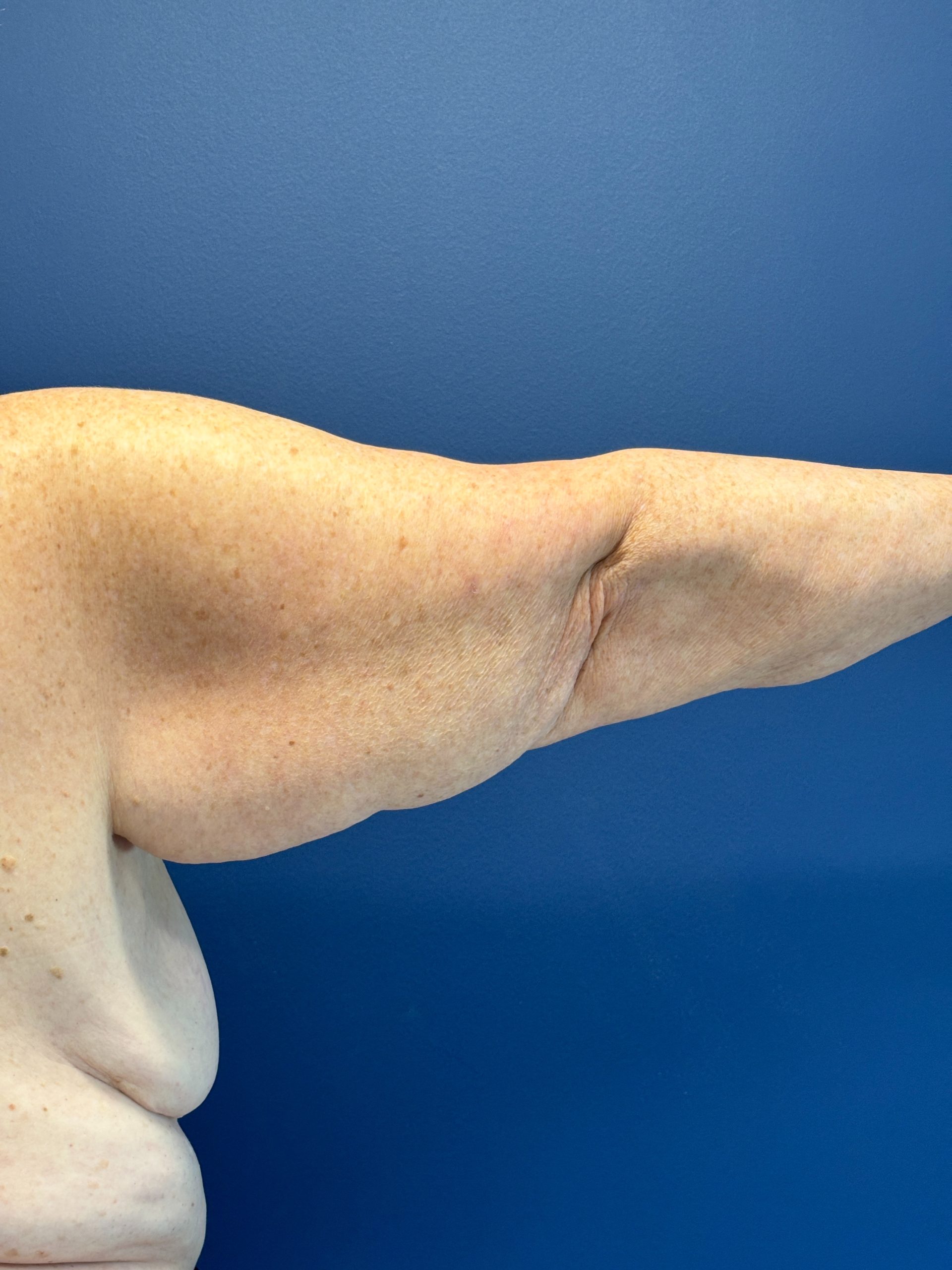 Brachioplasty-Case--3447 | Before Arm Lift 3