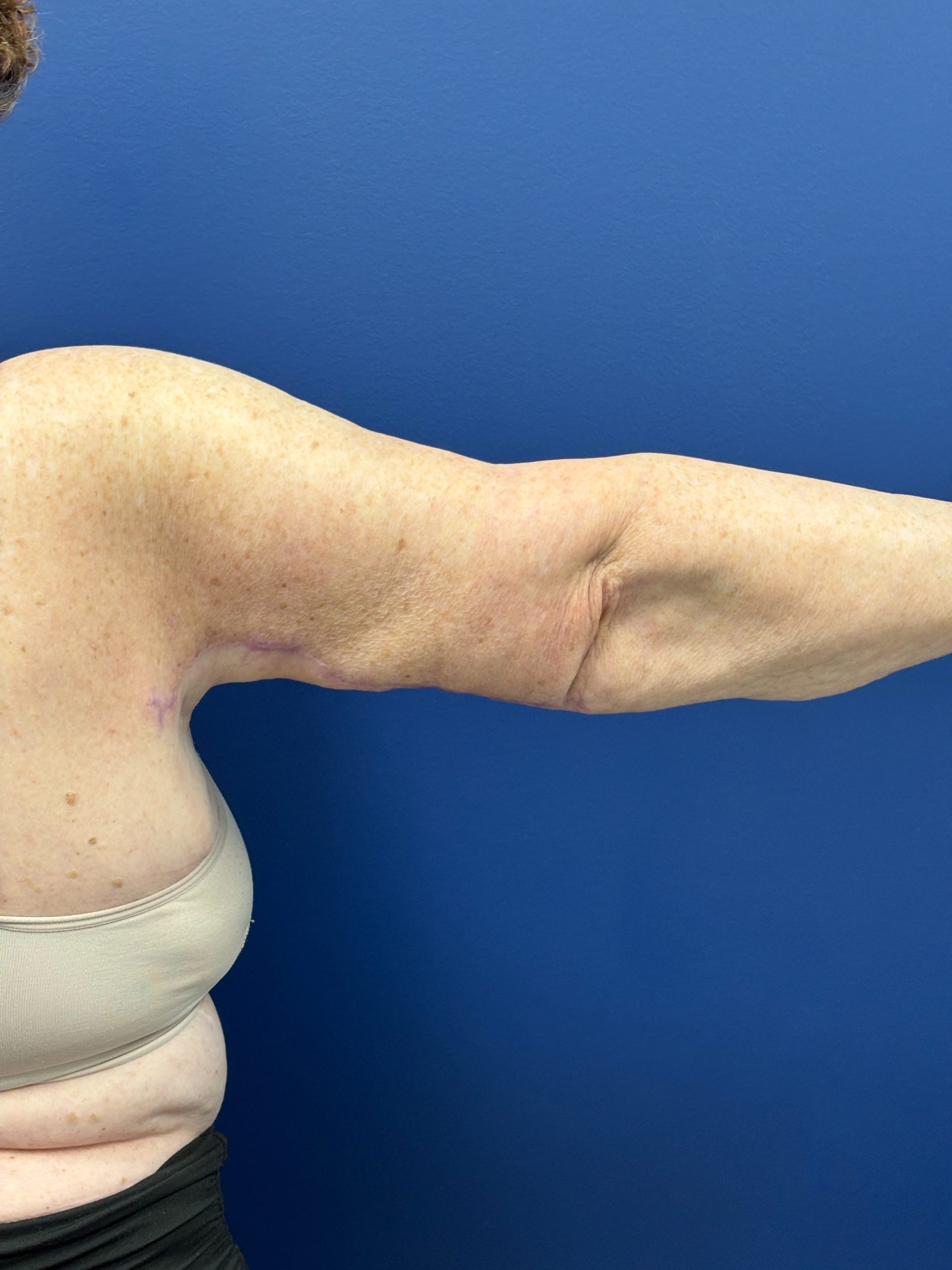 Brachioplasty-Case--3447 | After Arm Lift 3