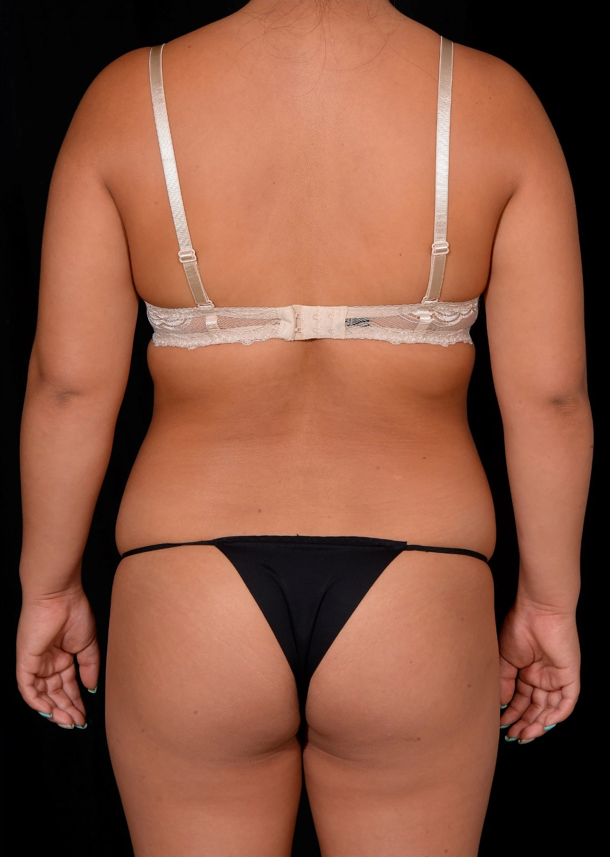 Brazilian-Butt-Lift-Case--367 | Before Brazilian Butt Lift 1