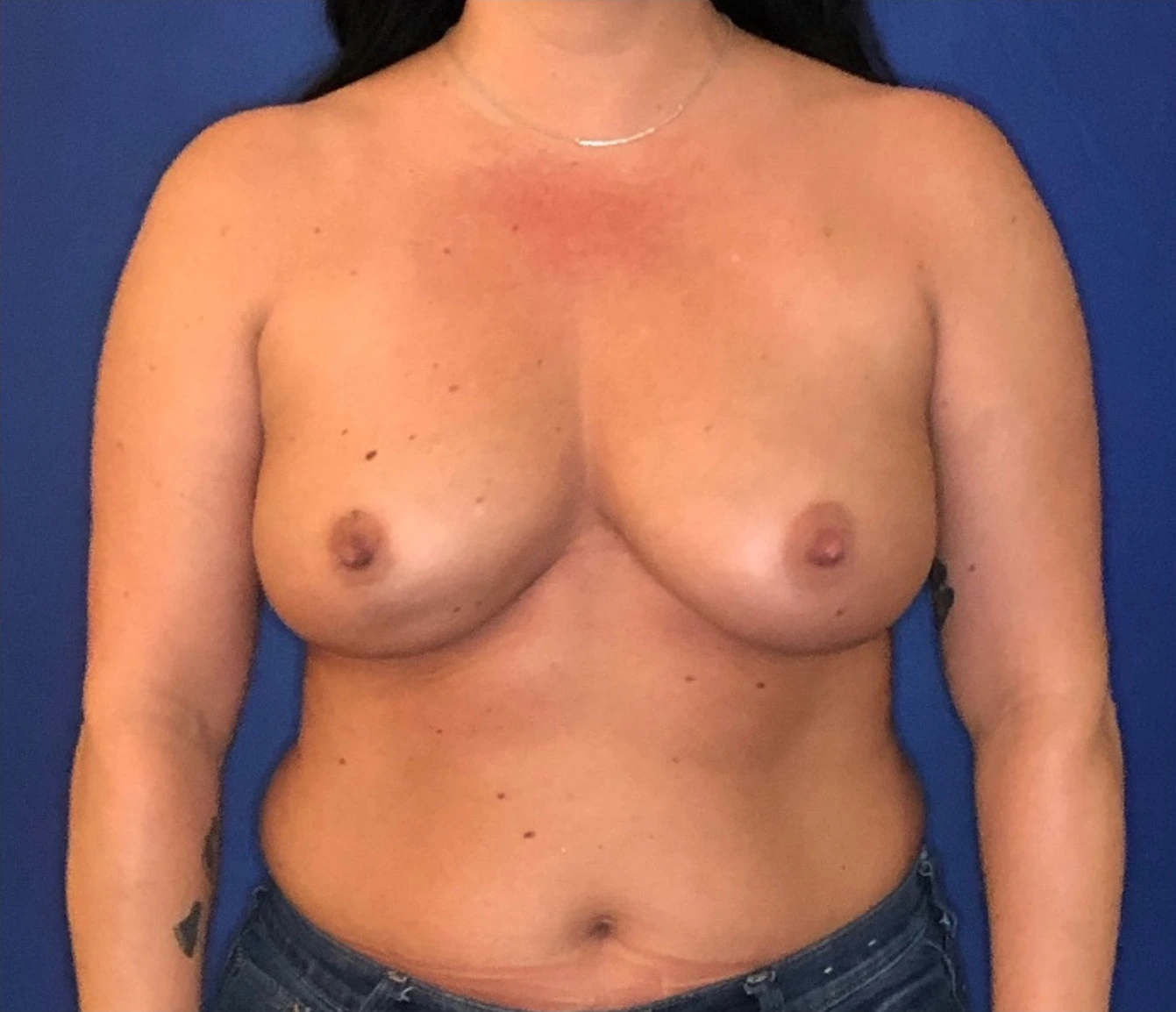 Breast-Reconstruction-Case--306 | Before Breast Reconstruction 1