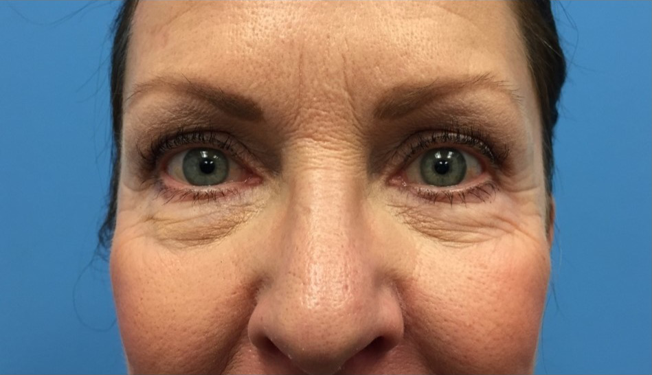 Lower-Blepharoplasty-Case--287 | Before Eyelid Surgery 1