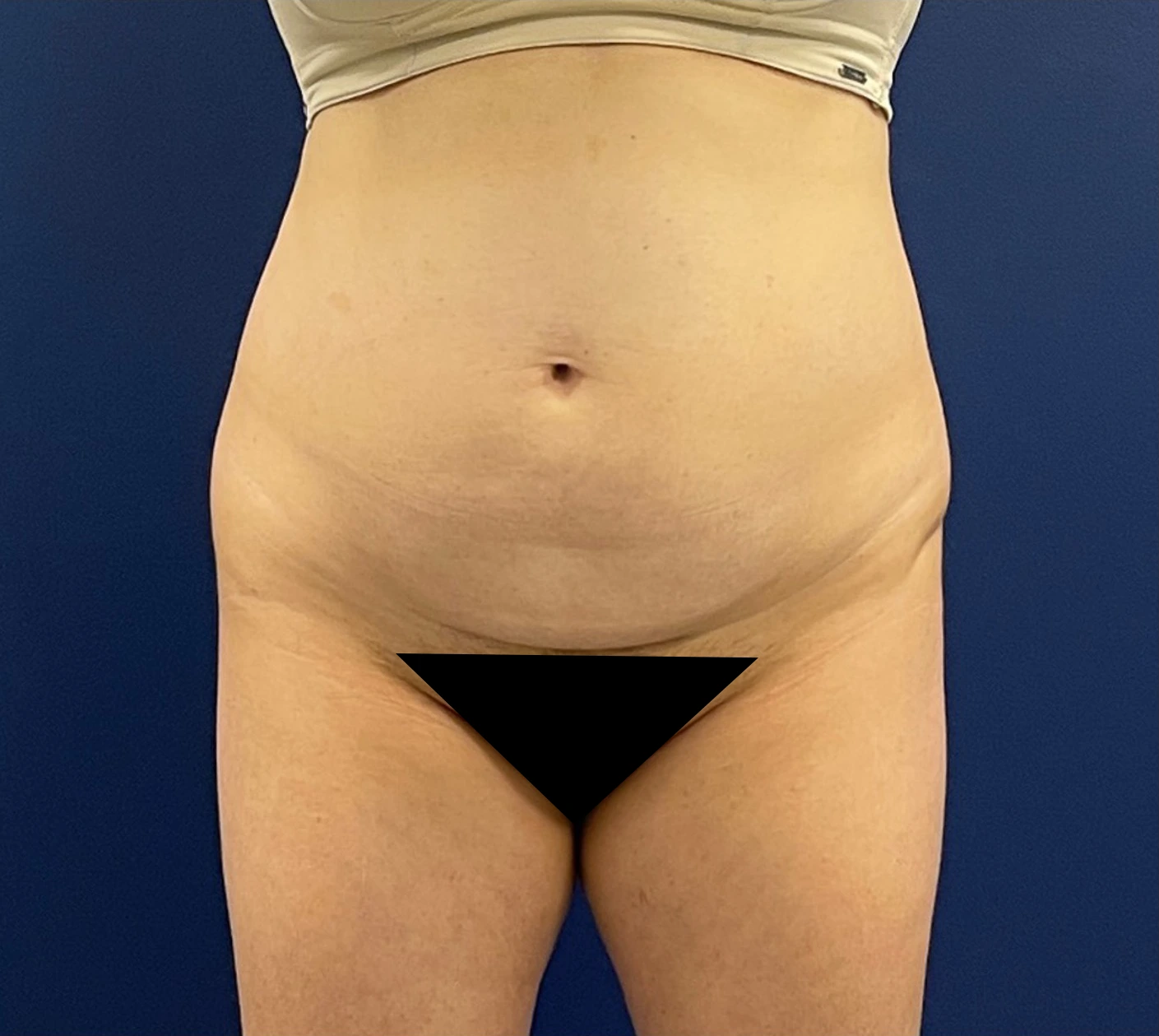 Tummy-Tuck-Case--256 | Before Body 1