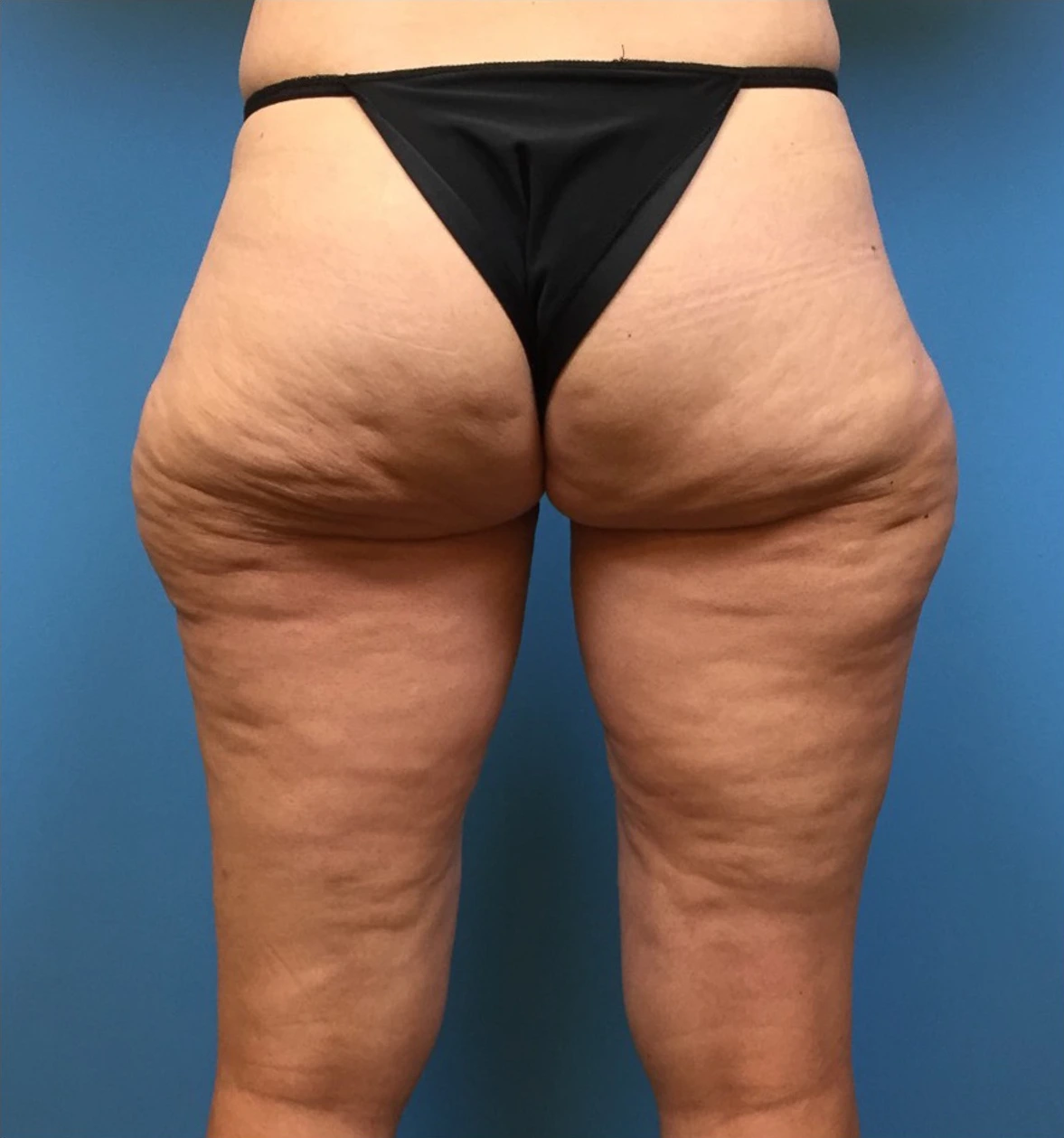 Case--281 | Before Body 2
