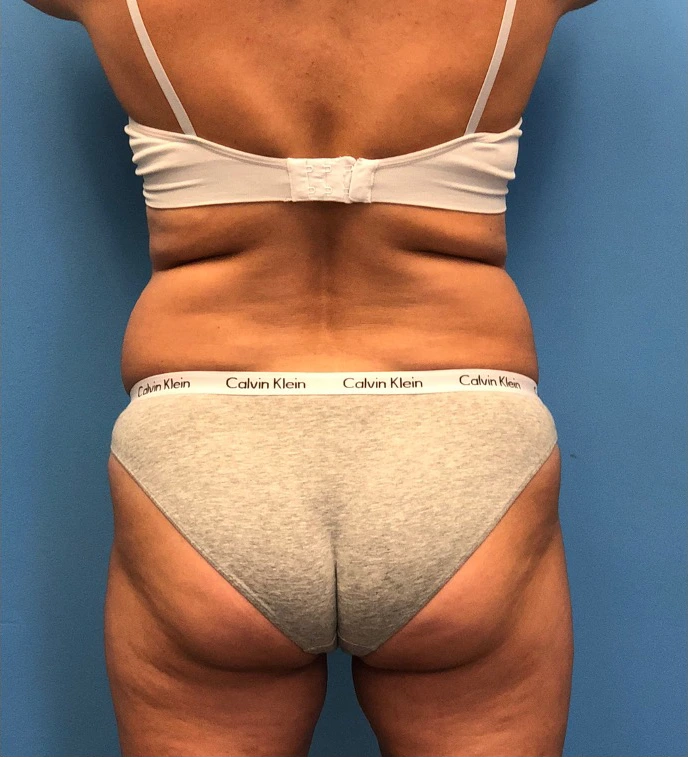 Case--14819 | Before Liposuction 4