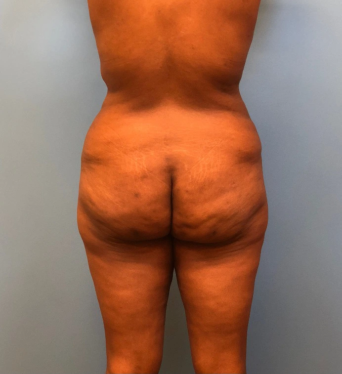 Mommy-Makeover-Case--13869 | Before Mommy Makeover 4