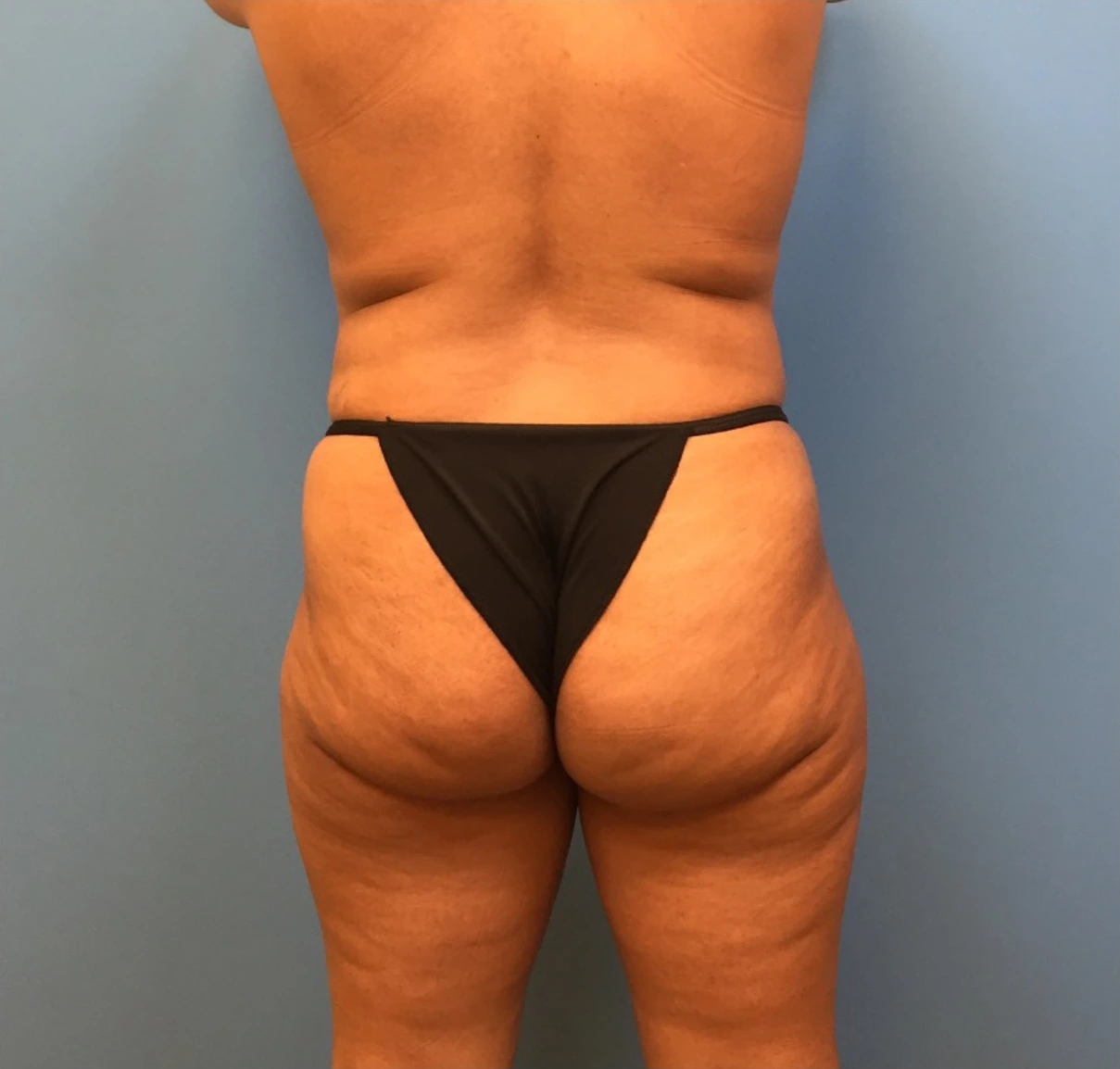 Case--247 | Before Body 2