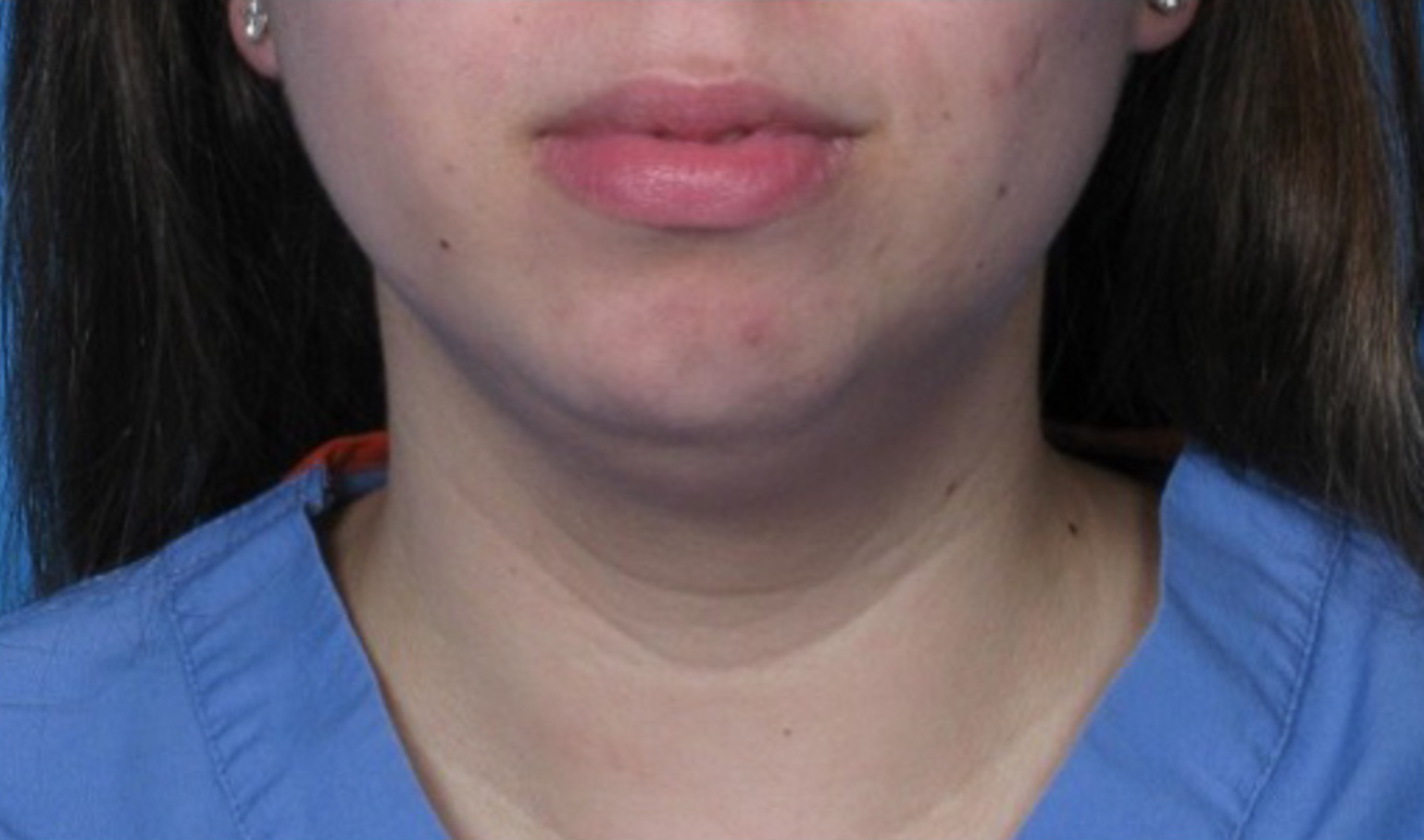 Case--293 | Before Submental Liposuction 1
