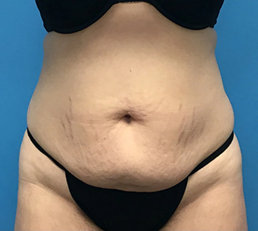 Case--56 | Before Liposuction 1