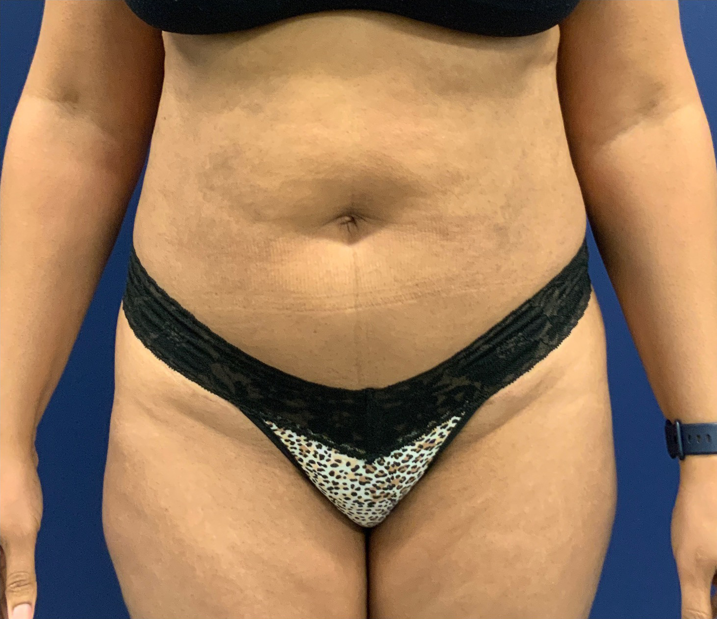 Lipoabdominoplasty-Case--21755 | Before Body 1
