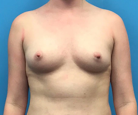 Case--94 | Before Breast Augmentation 1
