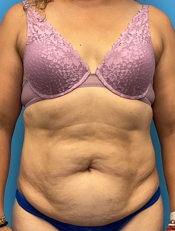 Tummy-Tuck-Case--25988 | Before Tummy Tuck 1