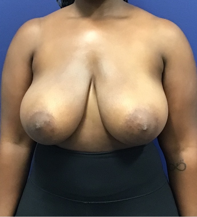 Breast-Reduction-Case--27530 | Before Dr. Arjun Kanuri 1
