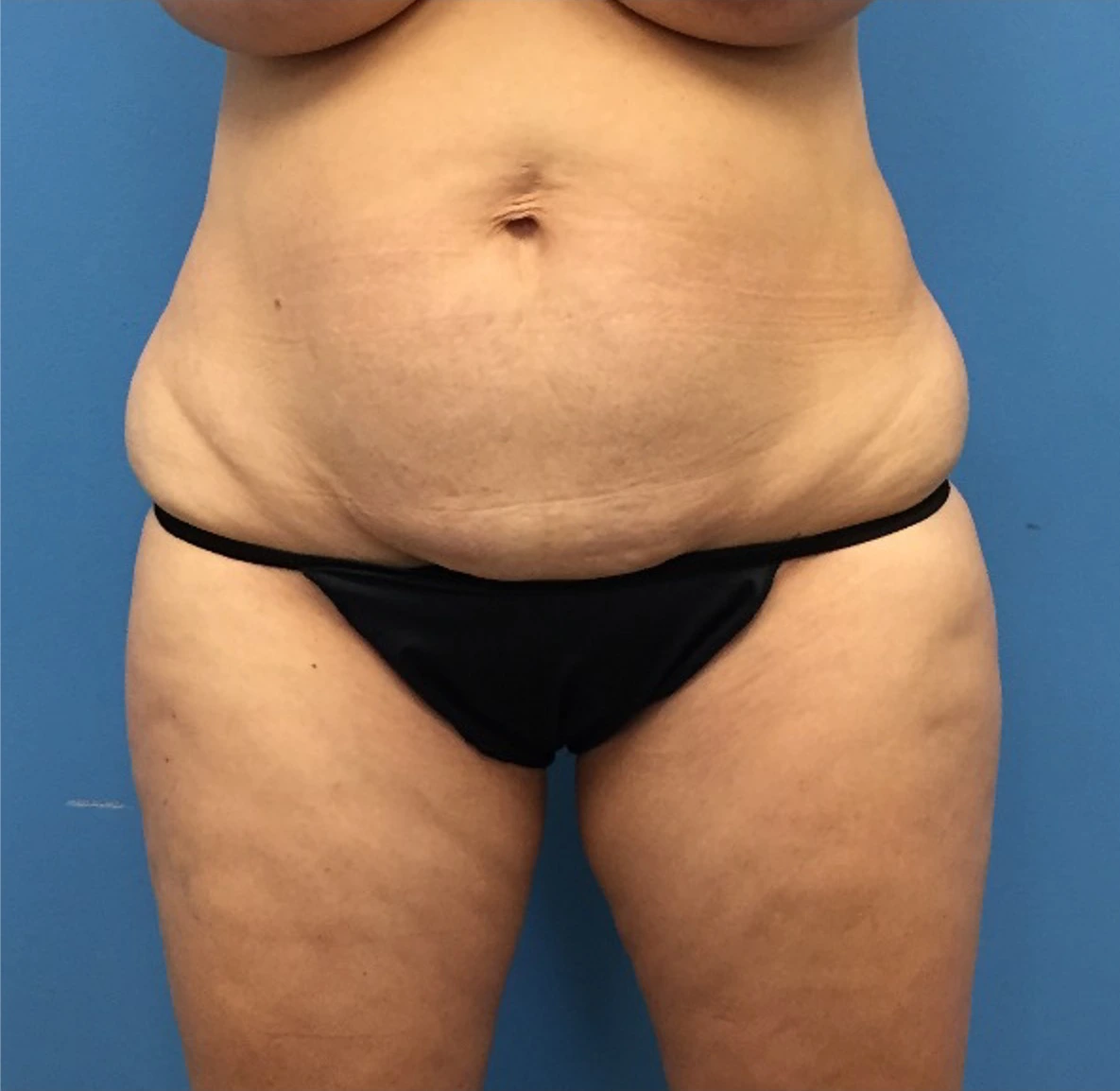 Case--248 | Before Body 1