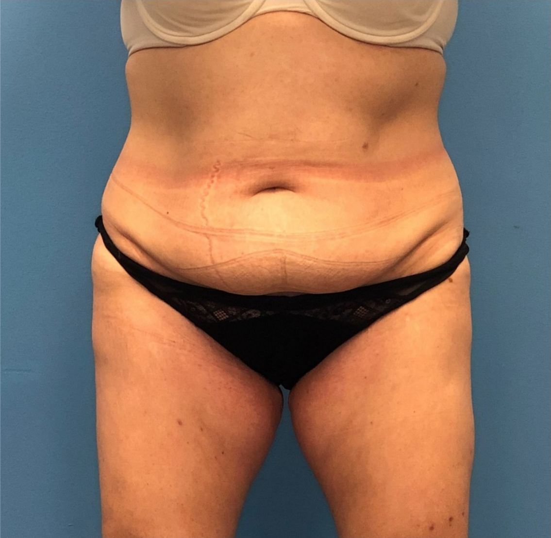 Case--251 | Before Body 1