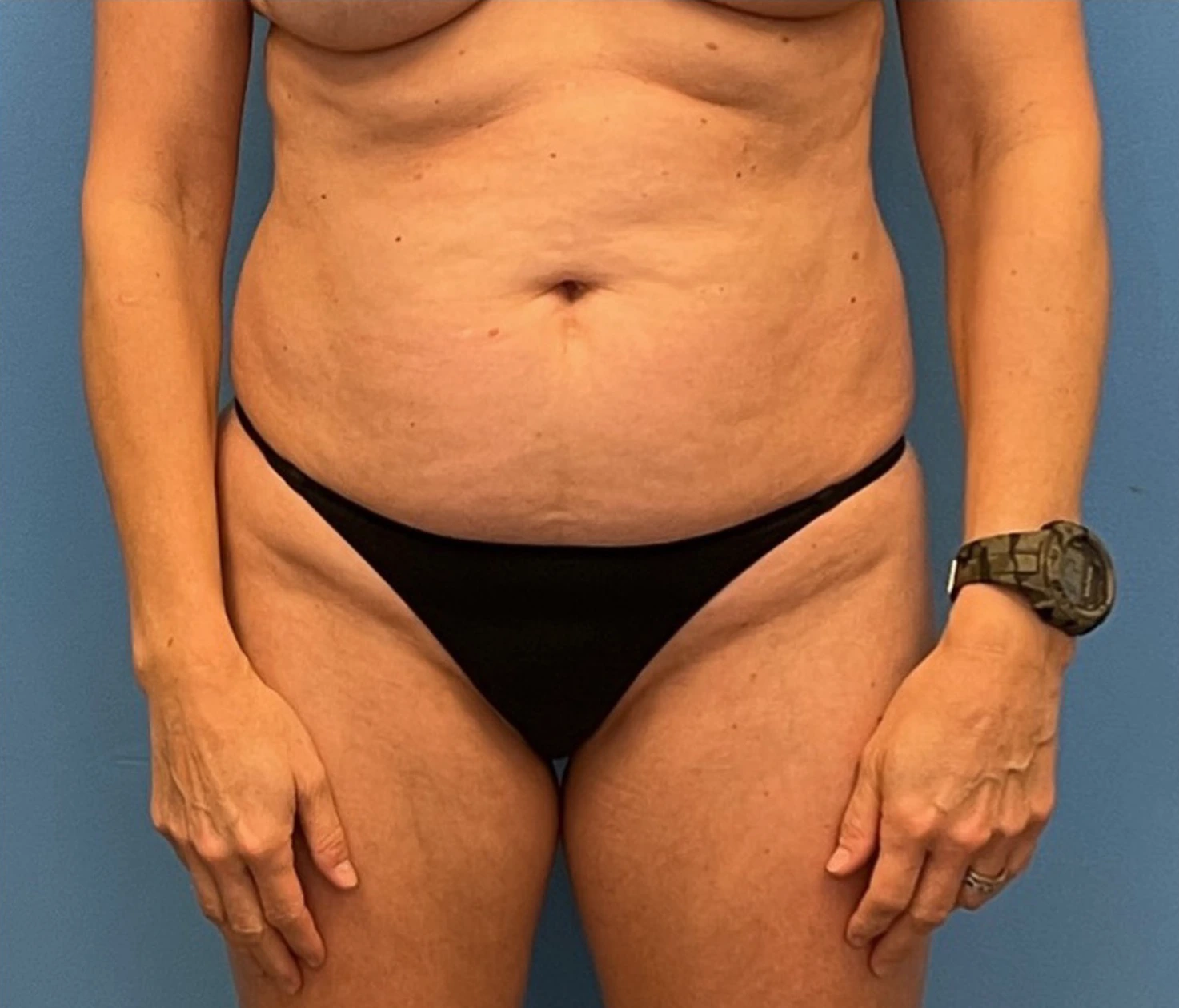 Case--253 | Before Body 1